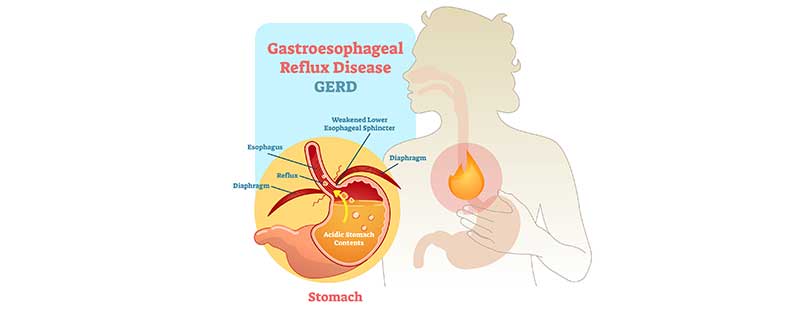 illustration-of-GERD-OC-Gastro-Clinic
