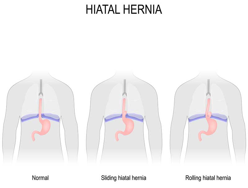 illustration-of-hiatal-hernia-OC-Gastro-Clinic