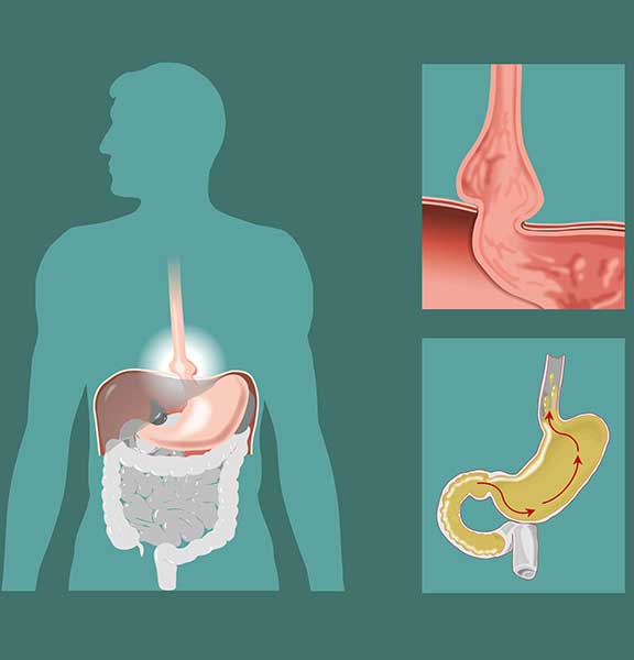 illustration-of-hiatal-hernia-OC-Gastro-Clinic