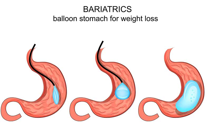 weight-loss-balloon-for-obesity-OC-Gastro-Clinic