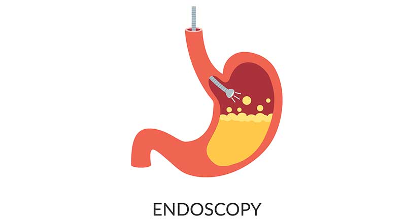 medical-concept-of-upper-Gi-endoscopy-OC-Gastro-Clinic