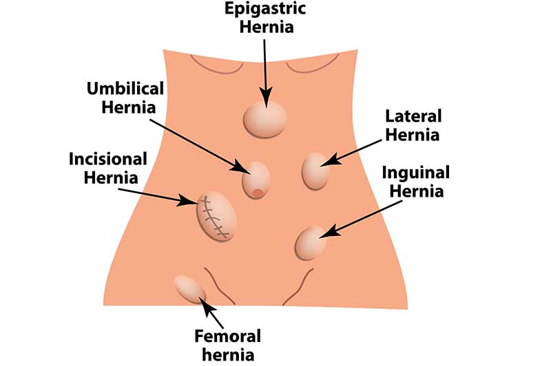 location-of-femoral-hernia-OC-Gastro-Clinic