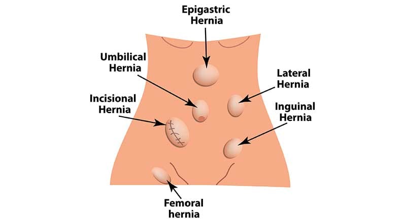 location-of-inguinal-hernia-OC-Gastro-Clinic