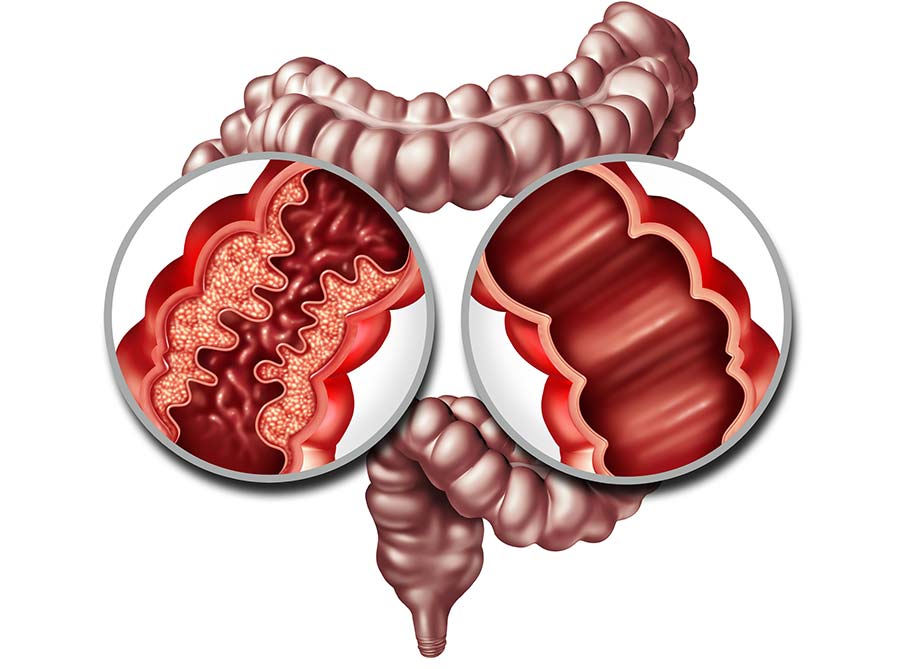 Crohn's-disease-and-healthy-intestine-Orange-County-Gastro-Clinic
